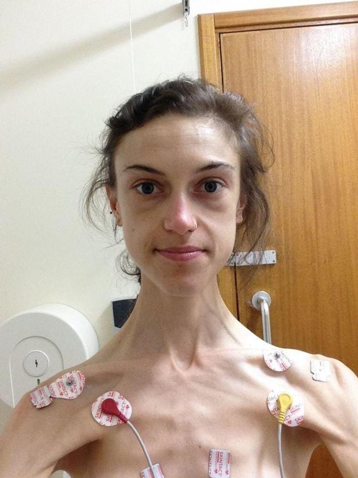 Taču slimība tevi muļķo... Autors: Bitchere Anorektiķes atzīšanās: Kā Instagrams izglāba manu dzīvību