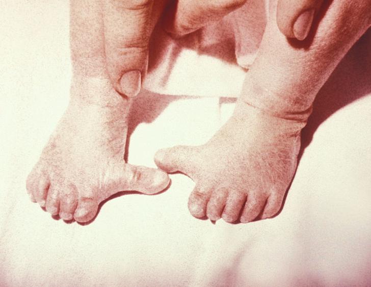 Polidaktilisms ir bieži... Autors: matilde Cilvēki dalās ar fotogrāfijām, kurās redzamas viņu dīvainākās ķermeņa daļas
