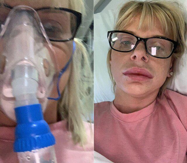 nbspMediķi iedeva viņai... Autors: matilde Neveiksmīga lūpu palielināšanas procedūra ar speciāli tam radītu krēmu