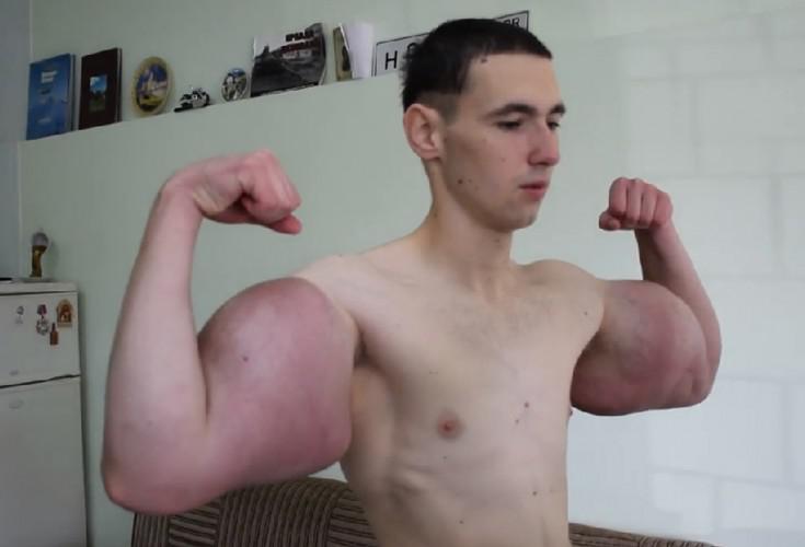 NSFW: Synthol Fiend Ruki Bazuki Pleads For Funding to Help Fix his Arms